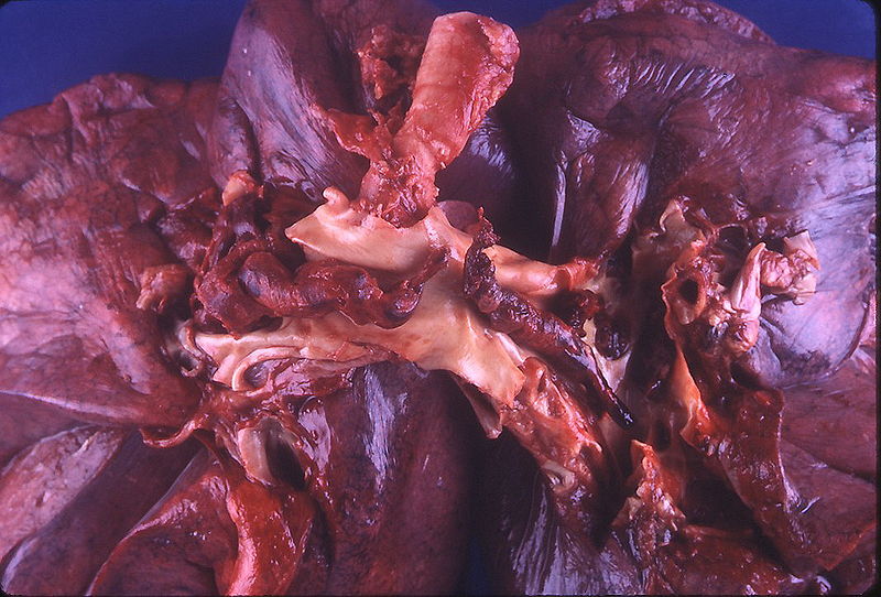 Lungenarterienembolie